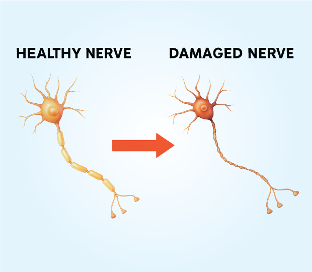 Nerve Damage